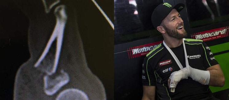 /sykes-dedo-roto.jpg