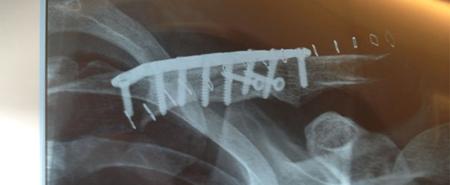 fractura colin edwards